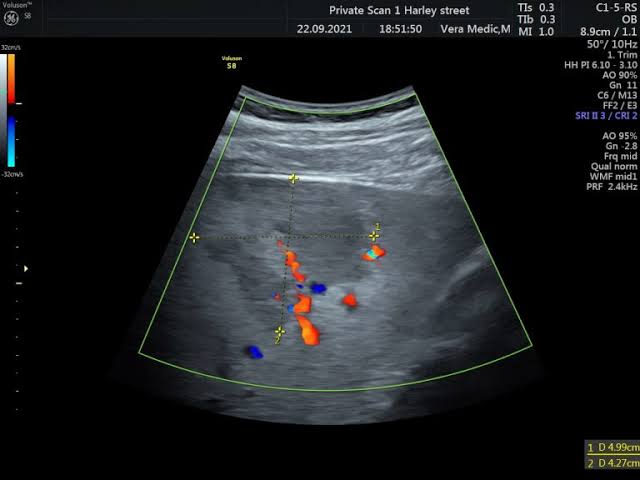 Ultrasound scan image on a clinic monitor